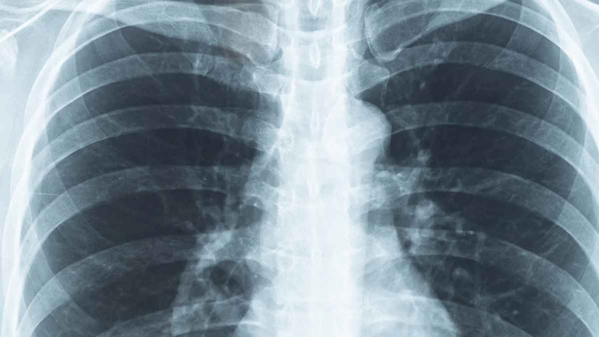 Radiografía del tórax y columna vertebral en el contexto de una incapacidad permanente por síndrome de espalda fallida