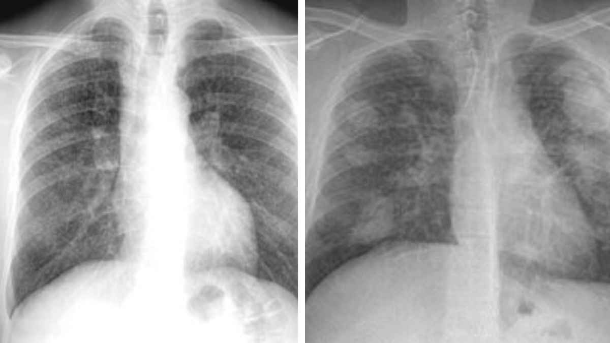 Radiografía pulmonar mostrando silicosis, enfermedad reconocida para pensión de incapacidad permanente.