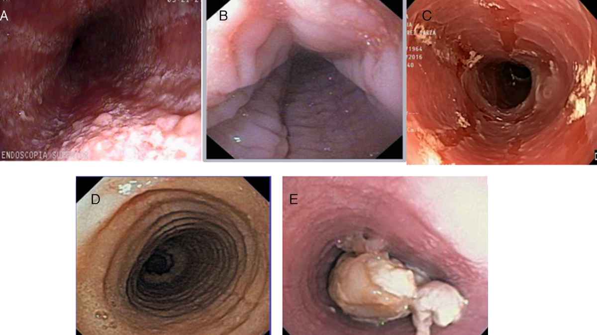 Endoscopia mostrando daños por esofagitis eosinofílica, enfermedad rara crónica causante de incapacidad permanente rechazada por el INSS
