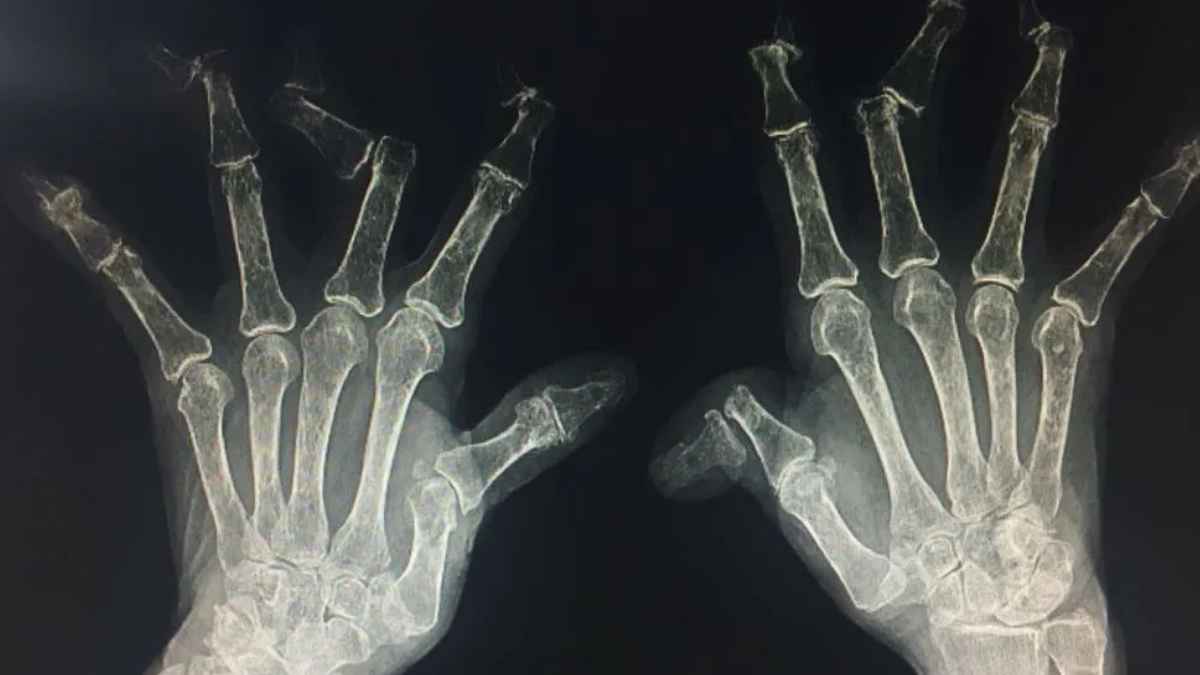Radiografía mostrando artrosis severa en manos, motivo válido para solicitar incapacidad permanente a la Seguridad Social