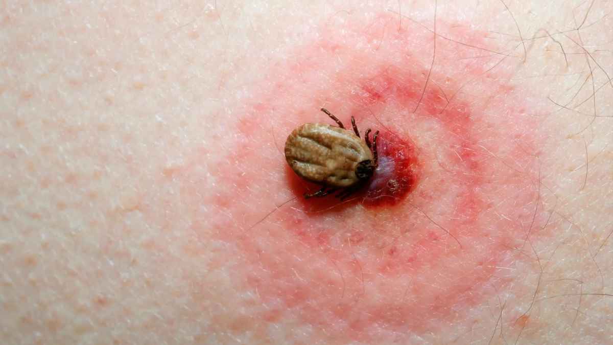 Garrapata incrustada en la piel causante de fiebre Crimea-Congo en Toledo