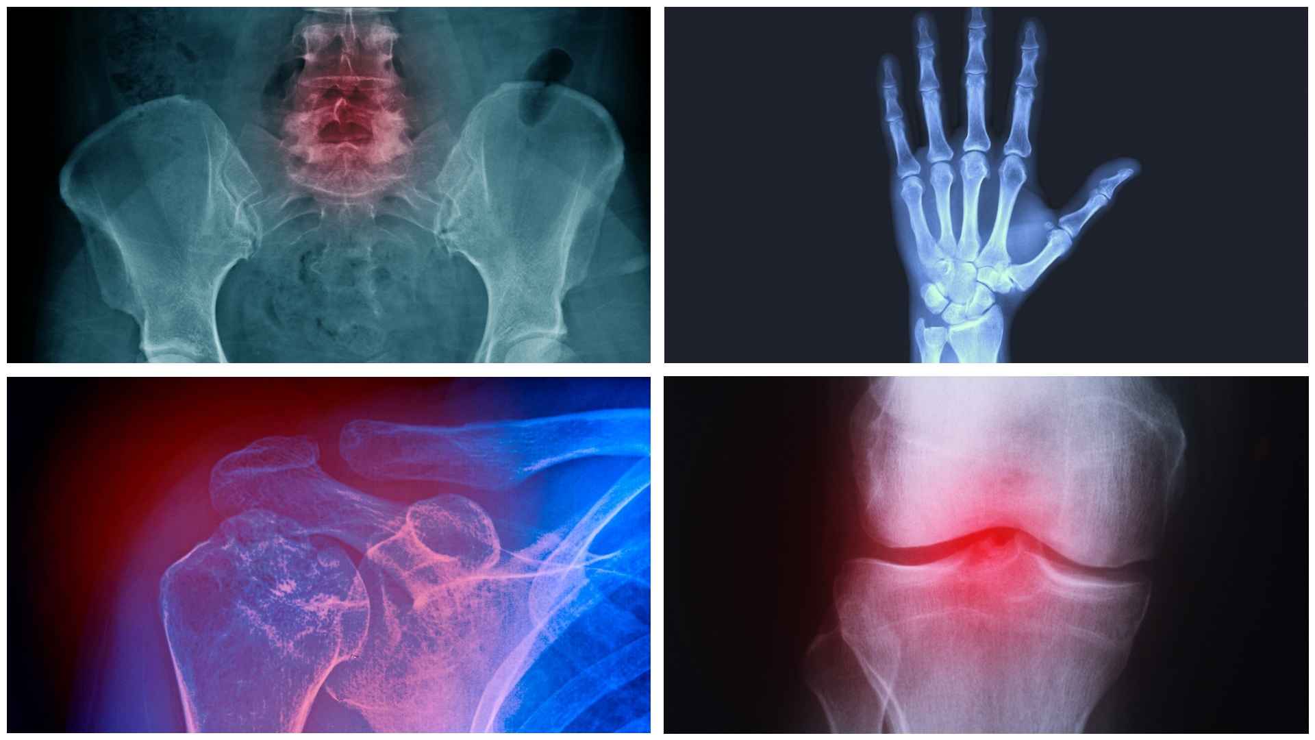 Radiografías de articulaciones con artrosis en cadera mano hombro y rodilla