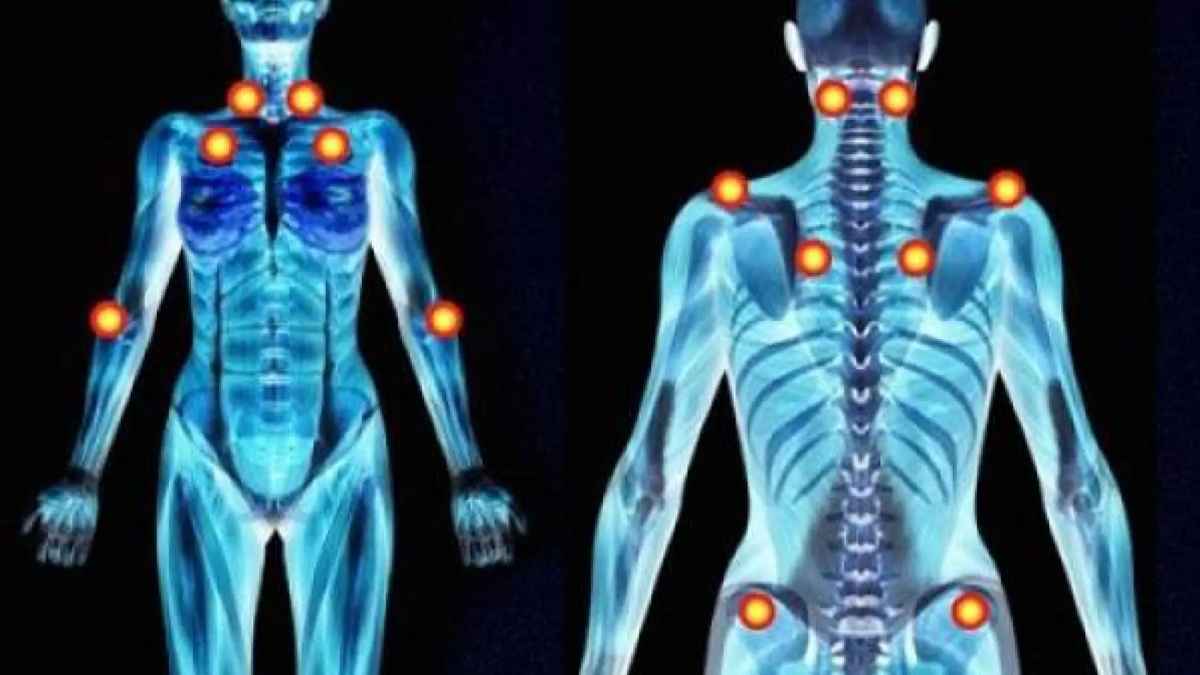 Puntos de dolor de la fibromialgia y fatiga crónica en el cuerpo humano