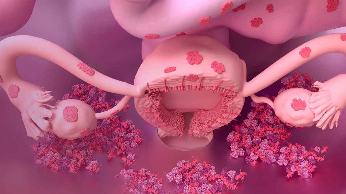 Ilustración médica de la endometriosis que provoca dolor crónico e incapacidad laboral en una peona agrícola