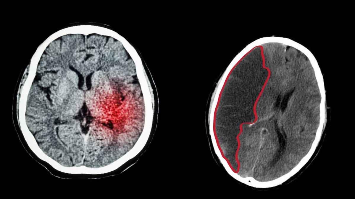 Infarto cerebral reflejado en una tomografía que derivó en una discapacidad del 34% y en un despido declarado nulo