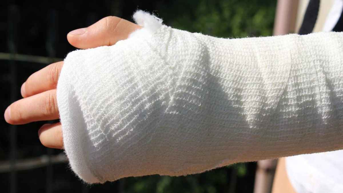 Trabajador con el brazo escayolado por una lesión laboral indemnizable por la Seguridad Social