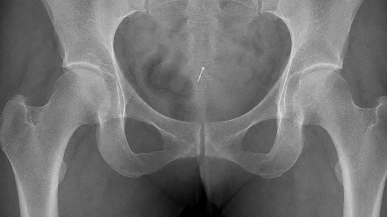 Radiografía de una pelvis con un fragmento metálico compatible con una aguja quirúrgica.